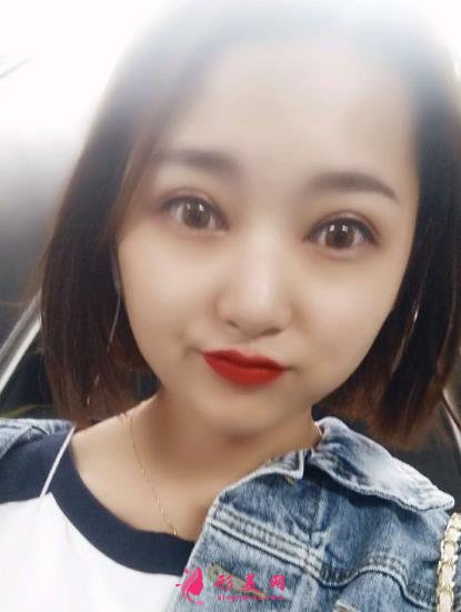 青岛市立医院双眼皮手术怎么样?附手术后注意事项盘点