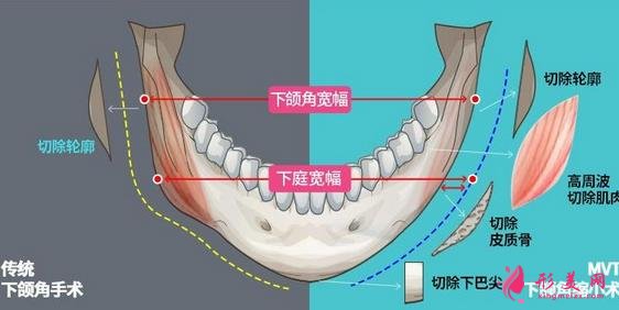 上海九院下颌角磨骨怎么样?特色技术分析和案例效果图汇总!你评评效果如何