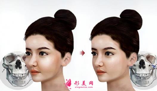 上海九院下颌角磨骨怎么样?特色技术分析和案例效果图汇总!你评评效果如何