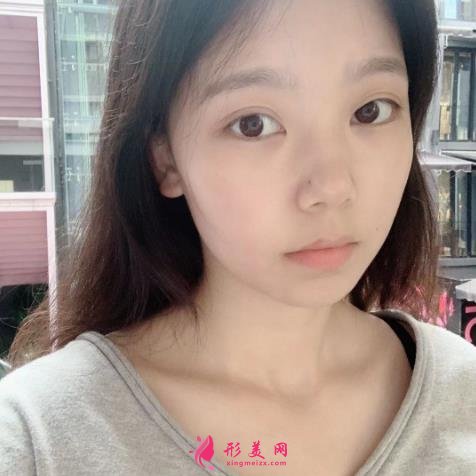 上海九院下颌角磨骨怎么样?特色技术分析和案例效果图汇总!你评评效果如何