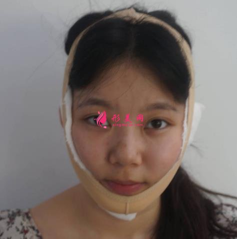 上海九院下颌角磨骨怎么样?特色技术分析和案例效果图汇总!你评评效果如何