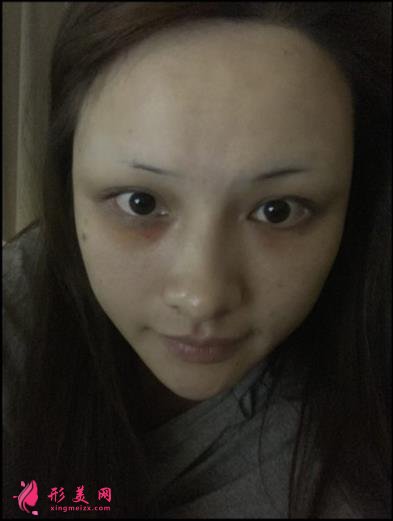 宁波壹加壹整形医院怎么样?从简介及激光去眼袋案例、价格收费可以看出