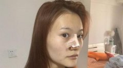 浙一医院鼻综合手术案例分享!鼻翼缩小术价格是多少钱?