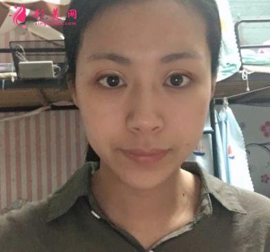 广州曙光医院做双眼皮手术怎么样?多少钱?眼整形案例及费用价格查询