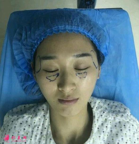 天津医院鼻综合怎么样?鼻翼缩小手术适合人群及价格分享