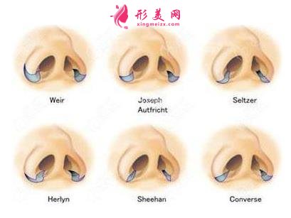 天津医院鼻综合怎么样?鼻翼缩小手术适合人群及价格分享