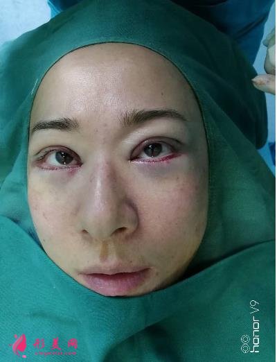 兰州市第二人民医院整形科全切双眼皮案例效果分享!前后变化太赞了