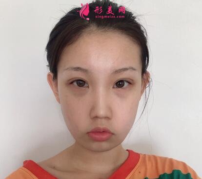 成都八大处整形医院隆鼻案例曝光!还有价格收费明细参考