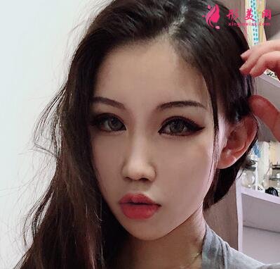 成都八大处整形医院隆鼻案例曝光!还有价格收费明细参考