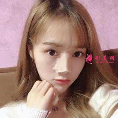 台州恩泽医院整形科隆鼻怎么样?2021价格价目表+案例恢复日记分享