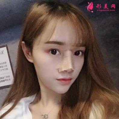 台州恩泽医院整形科隆鼻怎么样?2021价格价目表+案例恢复日记分享