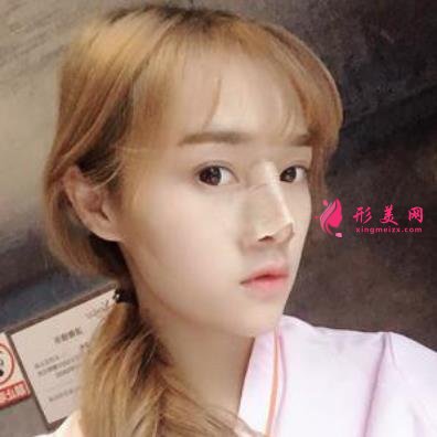 台州恩泽医院整形科隆鼻怎么样?2021价格价目表+案例恢复日记分享