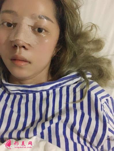 金华永康光大医疗美容隆鼻怎么样?案例效果图和价格价目表同步分享