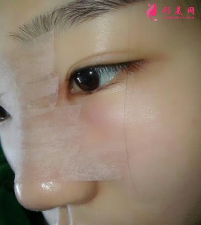 金华永康光大医疗美容隆鼻怎么样?案例效果图和价格价目表同步分享