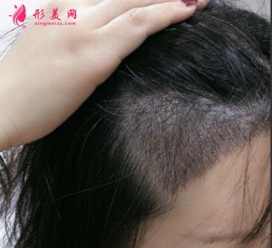 宁波市第六医院整复外科种植发际线怎么样?请看案例前后图片及价格收费