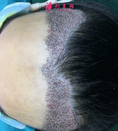 宁波市第六医院整复外科种植发际线怎么样?请看案例前后图片及价格收费