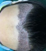 宁波市第六医院种植发际线怎么样？请看案例前后图片及价格收费