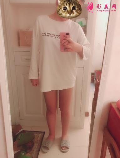 温州医科大学附属第二医院整形科吸脂怎么样?价格及案例分享