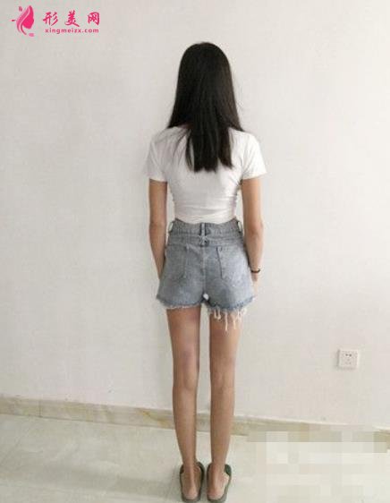 第四军医大学西京医院整形科吸脂效果咋样?案例价格收费表一览