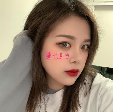 深圳北大医院整形外科做全切双眼皮怎么样?附案例实拍反馈及价格表