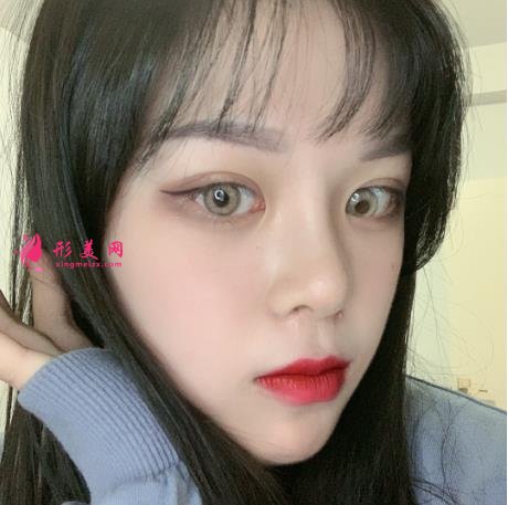 深圳北大医院整形外科做全切双眼皮怎么样?附案例实拍反馈及价格表