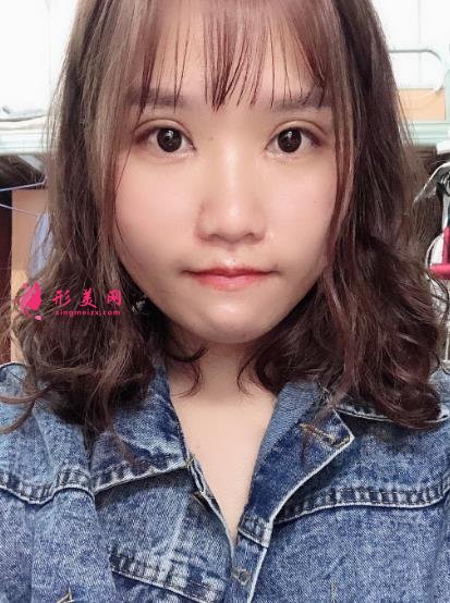 中日友好医院整形科双眼皮怎么样?开眼角留疤了怎么办?