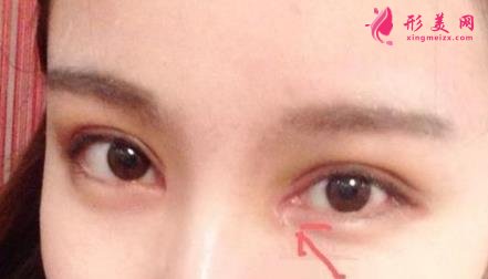 中日友好医院整形科双眼皮怎么样?开眼角留疤了怎么办?
