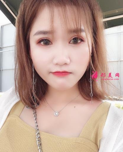 中日友好医院整形科双眼皮怎么样?开眼角留疤了怎么办?