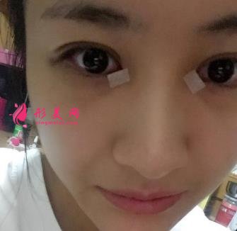 中日友好医院整形科双眼皮怎么样?开眼角留疤了怎么办?