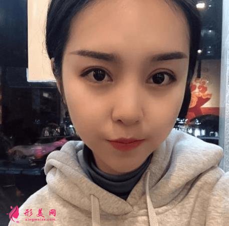 西安西京医院双眼皮怎么样?为什么开内眼角手术后眼角缩回?