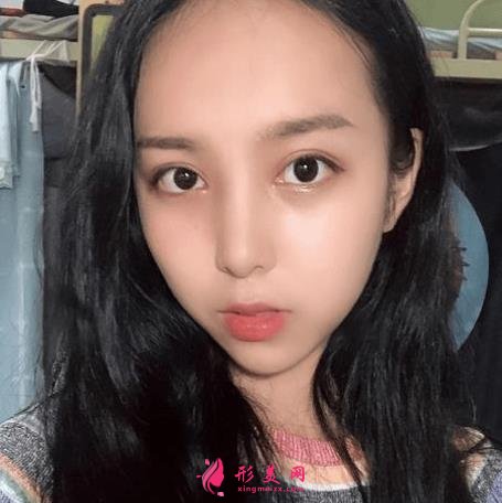 西安西京医院双眼皮怎么样?为什么开内眼角手术后眼角缩回?