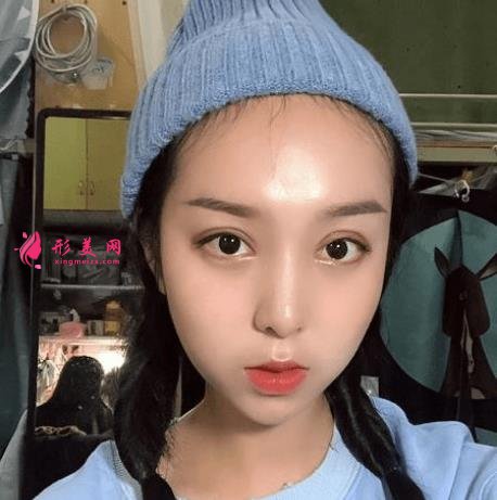 西安西京医院双眼皮怎么样?为什么开内眼角手术后眼角缩回?