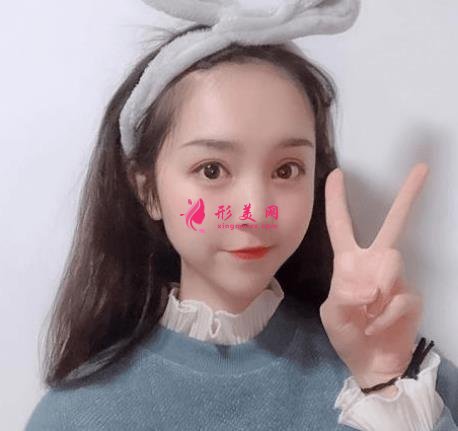 西安西京医院双眼皮怎么样?为什么开内眼角手术后眼角缩回?