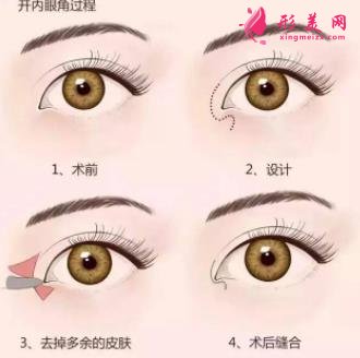 西安西京医院双眼皮怎么样?为什么开内眼角手术后眼角缩回?
