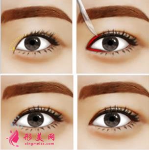 西安西京医院双眼皮怎么样?为什么开内眼角手术后眼角缩回?