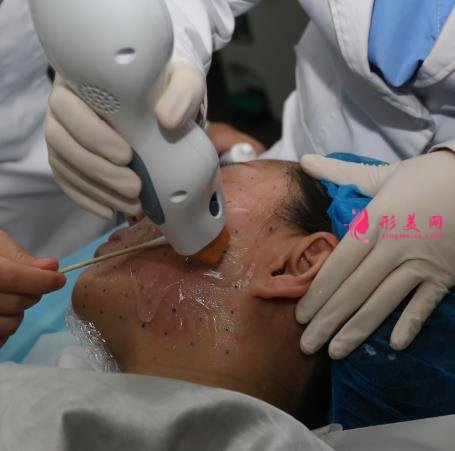 上海九院整形科热玛吉抗衰效果怎么样?看案例即可见证!附价格表