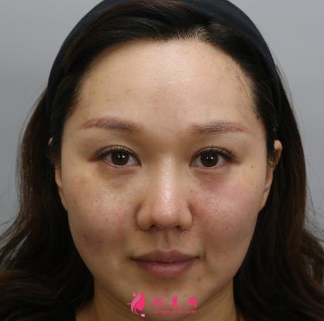 上海九院整形科热玛吉抗衰效果怎么样?看案例即可见证!附价格表