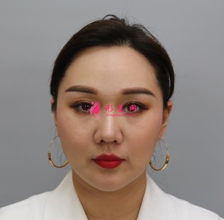 上海九院整形科热玛吉抗衰效果怎么样?看案例即可见证!附价格表