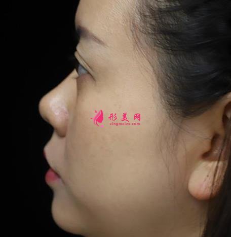 浙医二院整形科做热玛吉怎么样?专家案例、价格表清单一一尽显!