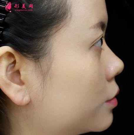 浙医二院整形科做热玛吉怎么样?专家案例、价格表清单一一尽显!