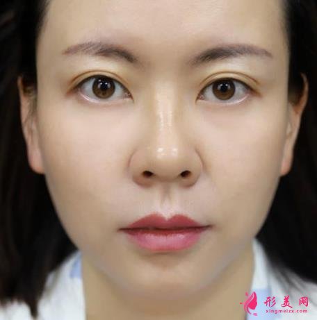 浙医二院整形科做热玛吉怎么样?专家案例、价格表清单一一尽显!