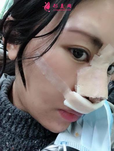 成都新丽美整形医院隆鼻怎么样?口碑案例和正规费用(价格表)一览