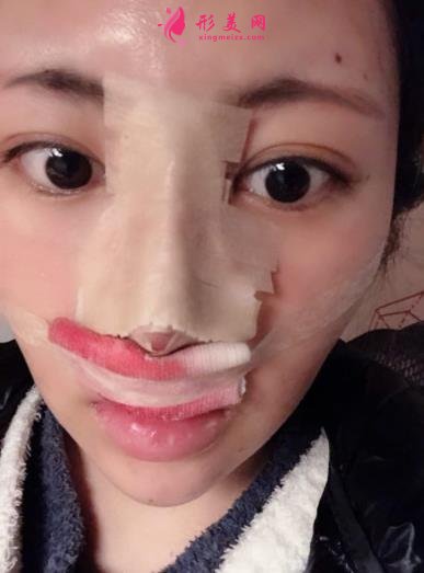 成都新丽美整形医院隆鼻怎么样?口碑案例和正规费用(价格表)一览