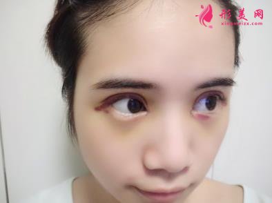 洛阳三院美容科做双眼皮怎么样?真实案例恢复图及价目价格全面了解