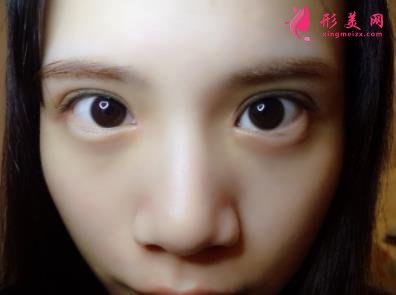 洛阳三院美容科做双眼皮怎么样?真实案例恢复图及价目价格全面了解