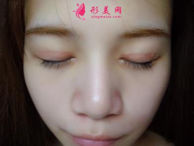洛阳三院美容科做双眼皮怎么样?真实案例恢复图及价目价格全面了解