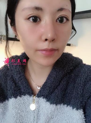 成都新丽美整形医院隆鼻怎么样?口碑案例和正规费用(价格表)一览