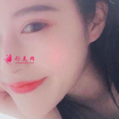 杭州整形医院(杭州手外科医院)做隆鼻怎么样?专家案例及价格价钱表反馈