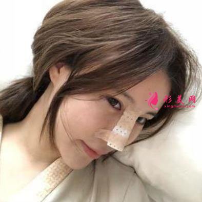 杭州整形医院(杭州手外科医院)做隆鼻怎么样?专家案例及价格价钱表反馈