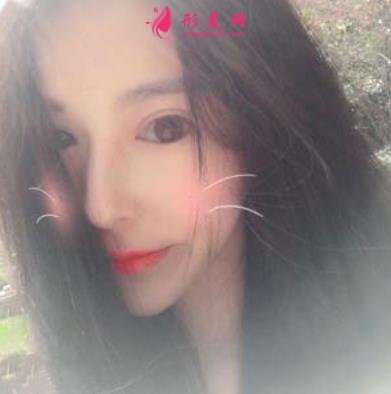 杭州整形医院(杭州手外科医院)做隆鼻怎么样?专家案例及价格价钱表反馈